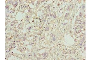 Immunohistochemistry of paraffin-embedded human pancreatic cancer using ABIN7163613 at dilution of 1:100 (PLA2G7 antibody  (AA 49-441))