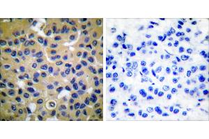 Peptide - +Immunohistochemical analysis of paraffin-embedded human breast carcinoma tissue using Collagen II antibody (#C0155).