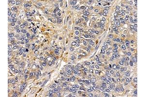 ABIN6260573 and ABIN6277931 at 1/100 staining human lung cancer by IHC-P.