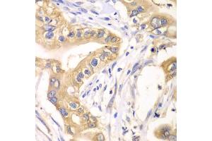 Immunohistochemistry of paraffin-embedded human liver cancer using HAGH antibody (ABIN5973978) at dilution of 1/100 (40x lens). (HAGH antibody)