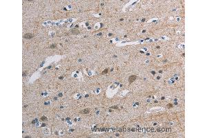 Immunohistochemistry of Human breast cancer using TONSL Polyclonal Antibody at dilution of 1:45 (NFKBIL2 antibody)