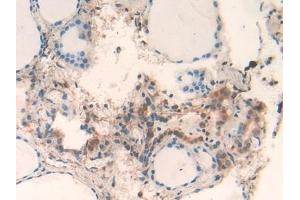 Detection of GAL2 in Human Thyroid Tissue using Polyclonal Antibody to Galectin 2 (GAL2) (Gallinacin-2 (GAL2) (AA 1-132) antibody)