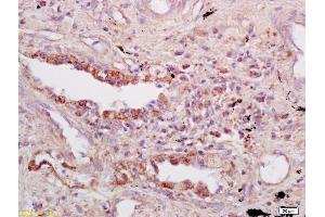 Formalin-fixed and paraffin embedded human lung carcinoma labeled with Anti-Tap1 Polyclonal Antibody, Unconjugated (ABIN680728) at 1:200 followed by conjugation to the secondary antibody and DAB staining (TAP1 antibody  (AA 501-600))