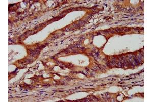 IHC image of ABIN7166102 diluted at 1:100 and staining in paraffin-embedded human colon cancer performed on a Leica BondTM system. (SEL1L antibody  (AA 22-181))