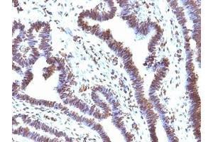 Formalin-fixed, paraffin-embedded human ovarian carcinoma stained with EMI1 antibody (EMI1/1176).