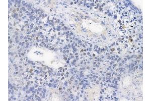 ABIN6254948 and ABIN6267278 at 1/100 staining human glioblastoma by IHC-P.