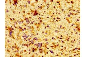 IHC image of ABIN7171423 diluted at 1:100 and staining in paraffin-embedded human glioma performed on a Leica BondTM system. (CCT7 antibody  (AA 240-543))