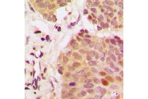 Immunohistochemical analysis of G3BP1 staining in human breast cancer formalin fixed paraffin embedded tissue section. (G3BP1 antibody  (Center))