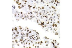 Immunohistochemistry of paraffin-embedded human liver cancer using NFKB2 Antibody (ABIN1873900) at dilution of 1:100 (40x lens). (NFKB2 antibody)