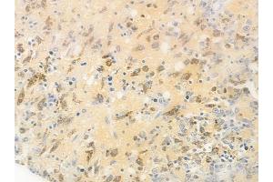 ABIN6255267 and ABIN6267477 at 1/100 staining human melanoma by IHC-P. (beta Catenin antibody  (pSer37))