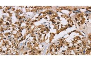 Immunohistochemistry of paraffin-embedded Human thyroid cancer using HNRNP L Polyclonal Antibody at dilution of 1:40 (HNRNPL antibody)