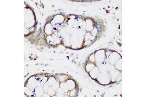 Immunohistochemistry of paraffin-embedded human gastric using MTDH antibody at dilution of 1:200 (40x lens). (MTDH antibody)