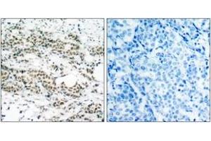 Immunohistochemistry analysis of paraffin-embedded human breast carcinoma, using AFX (Phospho-Ser197) Antibody. (FOXO4 antibody  (pSer197))