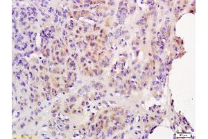 Formalin-fixed and paraffin embedded human endometrial cancer labeled with Anti-IL-6R Beta/CD130/gp130 Polyclonal Antibody, Unconjugated (ABIN686842) followed by conjugation to the secondary antibody and DAB staining (CD130/gp130 antibody  (AA 651-750))