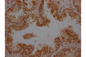 IHC image of ABIN7127866 diluted at 1:100 and staining in paraffin-embedded human prostate cancer performed on a Leica BondTM system. (Recombinant PLAU antibody)