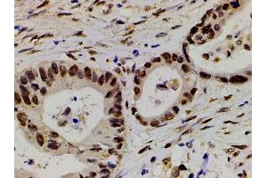 ABIN6267554 at 1/200 staining human colon cancer tissue sections by IHC-P.