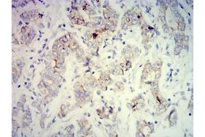 Immunohistochemical analysis of paraffin-embedded stomach cancer tissues using PCK2 mouse mAb with DAB staining. (PEPCK antibody  (AA 44-175))