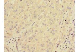 Immunohistochemistry of paraffin-embedded human liver cancer using ABIN7165964 at dilution of 1:100 (PPM1M antibody  (AA 1-247))