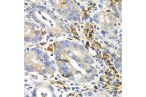 Immunohistochemistry of paraffin-embedded human gastric cancer using AIMP1 antibody. (AIMP1 antibody)