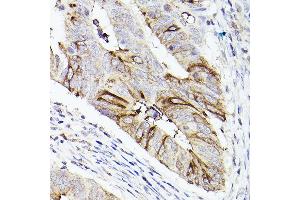 Immunohistochemistry of paraffin-embedded human colon carcinoma using Mucin 5AC (MUC5AC) antibody (ABIN7268694) at dilution of 1:50 (40x lens).