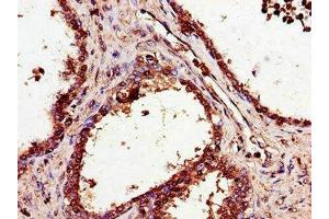 Immunohistochemistry of paraffin-embedded human prostate cancer using ABIN7170549 at dilution of 1:100 (SMS antibody  (AA 16-191))