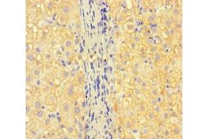 Immunohistochemistry of paraffin-embedded human liver cancer using ABIN7157130 at dilution of 1:100 (ISPD antibody  (AA 1-264))