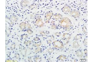Formalin-fixed and paraffin embedded human gastric cancer labeled with Anti-ING1/p33 Polyclonal Antibody, Unconjugated (ABIN674514) followed by conjugation to the secondary antibody and DAB staining (ING1 antibody  (AA 301-422))
