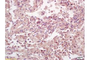 Formalin-fixed and paraffin embedded human lung carcinoma labeled with Anti-Phospho-ELk1(Ser383) Polyclonal Antibody, Unconjugated (ABIN1714907) at 1:200 followed by conjugation to the secondary antibody and DAB staining. (ELK1 antibody  (pSer383))