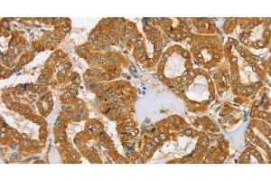 Immunohistochemistry of paraffin-embedded Human thyroid cancer tissue using PDP1 Polyclonal Antibody at dilution 1:30 (PDP antibody)