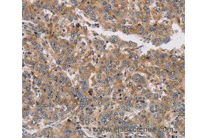 Immunohistochemistry of Human colon cancer using KCNG1 Polyclonal Antibody at dilution of 1:40