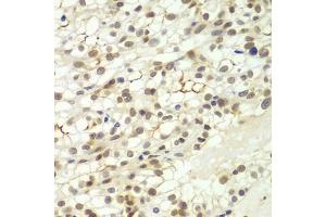 Immunohistochemistry of paraffin-embedded human kidney cancer using LHX4 antibody (ABIN6128183, ABIN6143193, ABIN6143194 and ABIN6224097) at dilution of 1:100 (40x lens). (LHX4 antibody  (AA 121-390))
