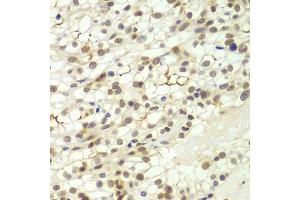Immunohistochemistry of paraffin-embedded human kidney cancer using LHX4 antibody (ABIN6128183, ABIN6143193, ABIN6143194 and ABIN6224097) at dilution of 1:100 (40x lens). (LHX4 antibody  (AA 121-390))