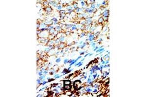 Formalin-fixed and paraffin-embedded human cancer tissue reacted with the primary antibody, which was peroxidase-conjugated to the secondary antibody, followed by AEC staining. (NME4 antibody  (C-Term))