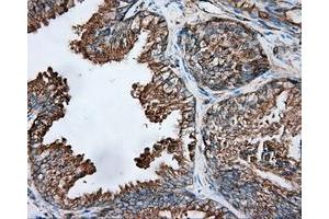 Immunohistochemical staining of paraffin-embedded Adenocarcinoma of ovary tissue using anti-TUBA8 mouse monoclonal antibody. (TUBA8 antibody)