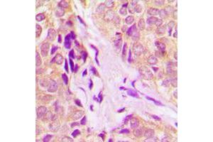 Immunohistochemical analysis of DDX55 staining in human breast cancer formalin fixed paraffin embedded tissue section.
