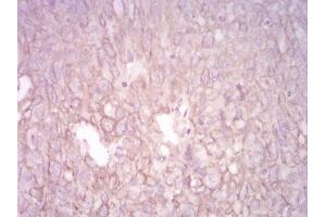 Immunohistochemical analysis of paraffin-embedded ovarian cancer tissues using CK5 mouse mAb with DAB staining. (Cytokeratin 5 antibody  (AA 258-357))