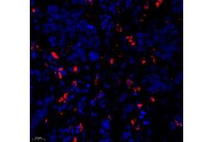 Immunofluorescence of paraffin embedded human esophagus cancer using c-caspase3 (ABIN7073336) at dilution of 1:500 (400x lens) (Caspase 3 antibody  (cleaved))