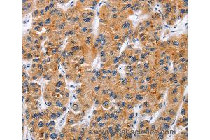Immunohistochemistry of Human gastric cancer using TNFRSF9 Polyclonal Antibody at dilution of 1:50 (CD137 antibody)
