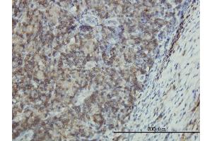 Immunoperoxidase of monoclonal antibody to EMP3 on formalin-fixed paraffin-embedded human lymphoma tissue.