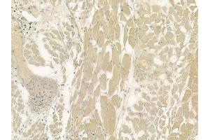 ABIN6263594 and ABIN6276436 at 1/100 staining human lung adenocarcinoma by IHC-P.