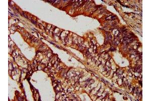 IHC image of ABIN7170916 diluted at 1:300 and staining in paraffin-embedded human colon cancer performed on a Leica BondTM system. (SUCLG2 antibody  (AA 161-292))