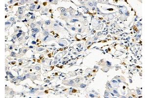 ABIN7094471 and ABIN7098519 at 1/100 staining Human prostate cancer by IHC-P.