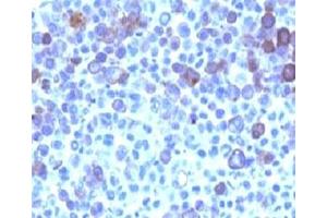 Formalin-fixed, paraffin-embedded human melanoma stained with Glypican-3 antibody