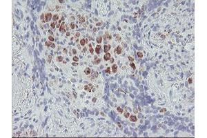 Immunohistochemical staining of paraffin-embedded Carcinoma of Human lung tissue using anti-ACSF2 mouse monoclonal antibody.