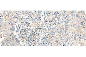 Immunohistochemistry of paraffin-embedded Human cervical cancer tissue using GART Polyclonal Antibody at dilution of 1:30(x200) (GART antibody)