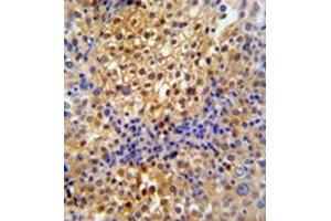 Formalin fixed and paraffin embedded human cervix carcinoma reacted with PRPF38A Antibody (C-term) followed by peroxidase conjugation of the secondary antibody and DAB staining (PRPF38A antibody  (C-Term))