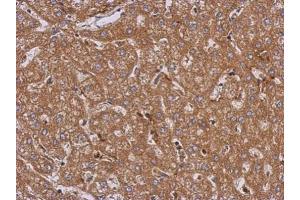 IHC-P Image Immunohistochemical analysis of paraffin-embedded human hepatoma, using LRRN2, antibody at 1:500 dilution. (LRRN2 antibody)