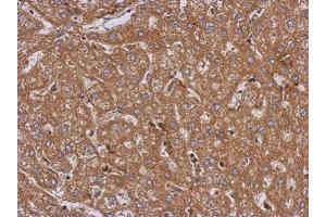 IHC-P Image Immunohistochemical analysis of paraffin-embedded human hepatoma, using LRRN2, antibody at 1:500 dilution.