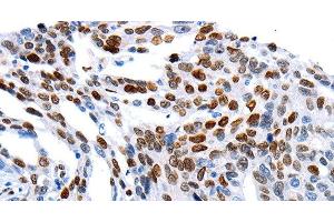 Immunohistochemistry of paraffin-embedded Human ovarian cancer using MUTYH Polyclonal Antibody at dilution of 1:60 (MUTYH antibody)