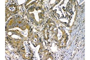 IHC testing of FFPE human rectal cancer tissue with CFD antibody at 1ug/ml. (Adipsin antibody  (AA 26-253))